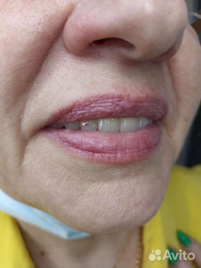 Скайсы, стразы на зубы