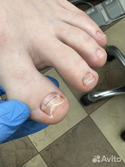Педикюр подолог