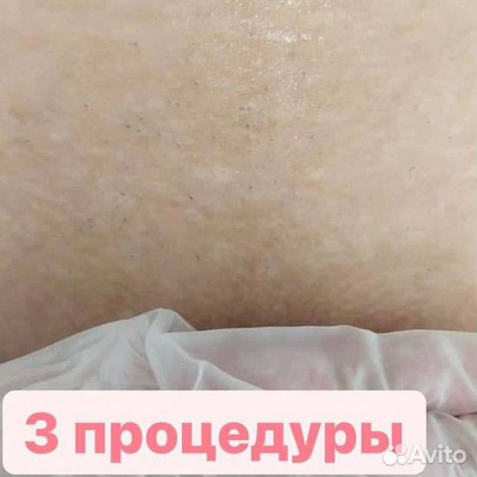 Лазерная эпиляция