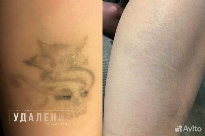 Лазерное удаление тату