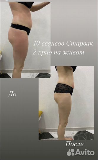 Криолиполиз