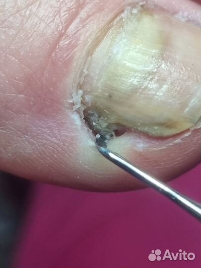 Титановая нить, Вросший ноготь. Подолог