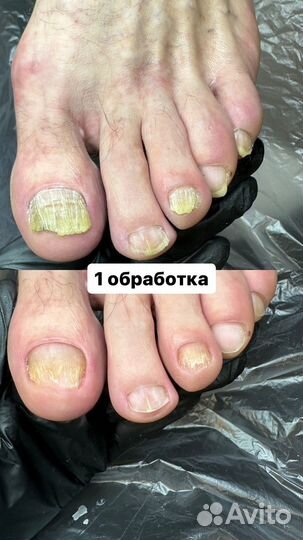 Лечебный педикюр, подолог