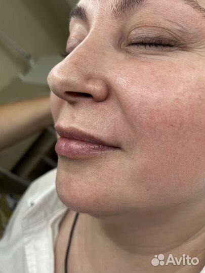 Контурная пластика