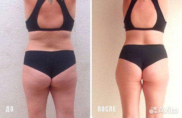 Эндосфера аппаратный массаж