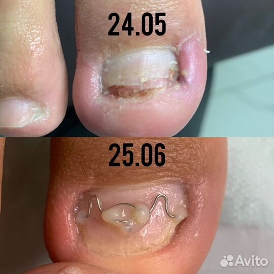 Педикюр, подолог, вросший ноготь