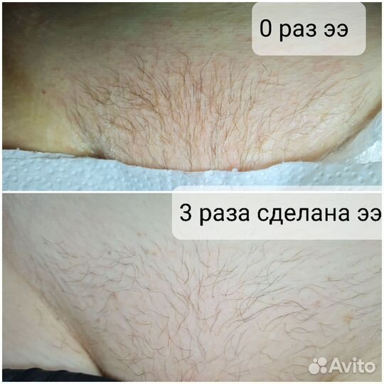 Электроэпиляция