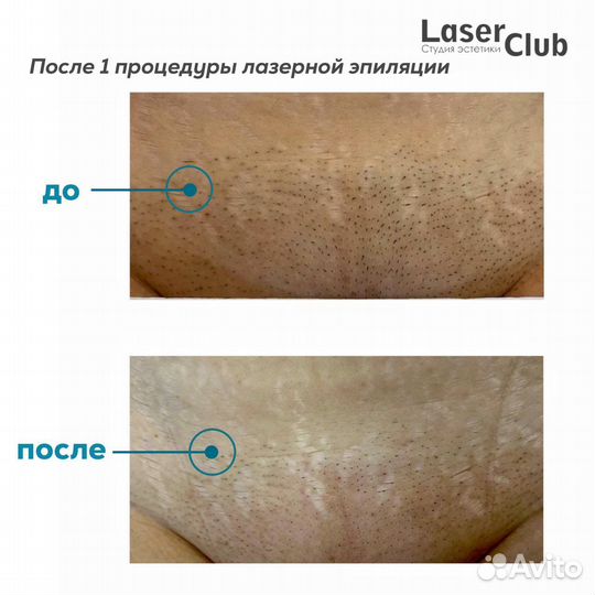 Лазерная эпиляция, массаж, косметология