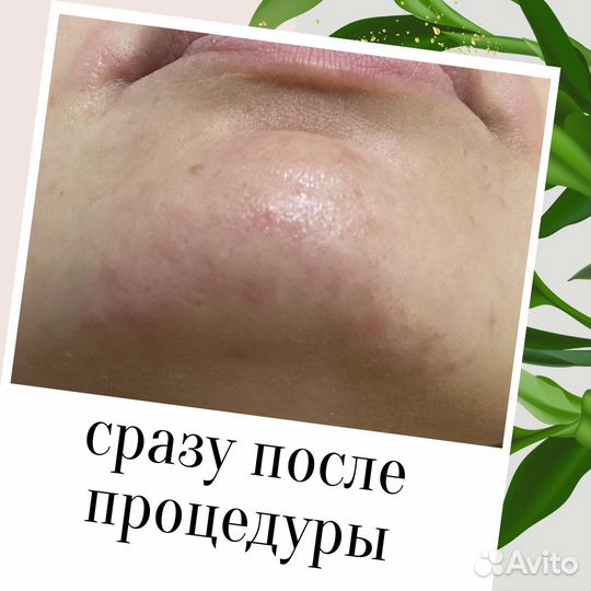 Электроэпиляция Apilus Cleo
