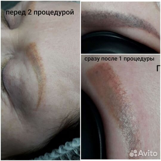 Удаление татуировок