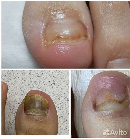 Медицинский педикюр