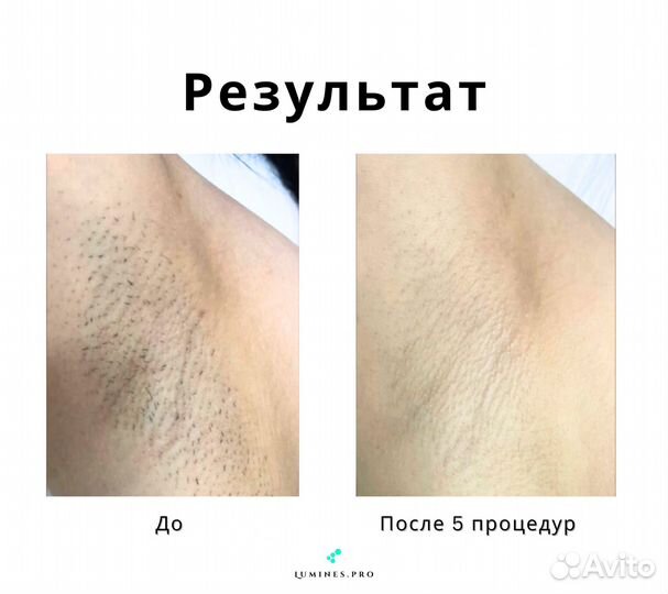 Диодный лазер Lumines. Макс-Ван 1200W