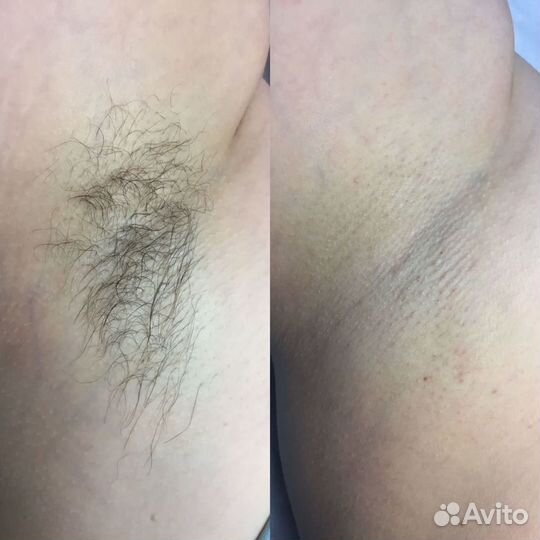 Шугаринг депиляция