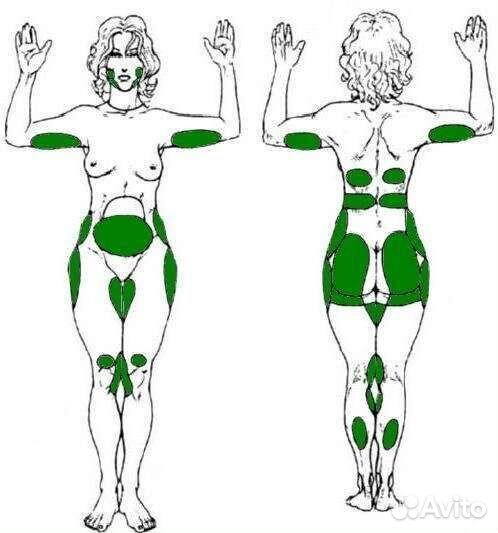 Процедура криолиполиз