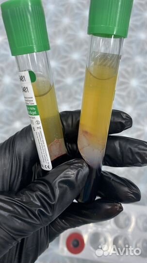 Плазмолифтинг