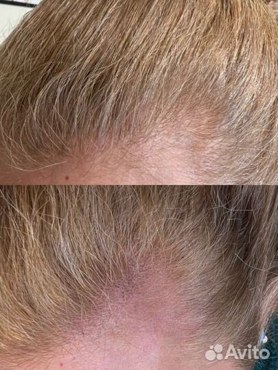 Трихопигментация