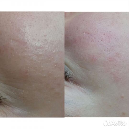 Чистка лица