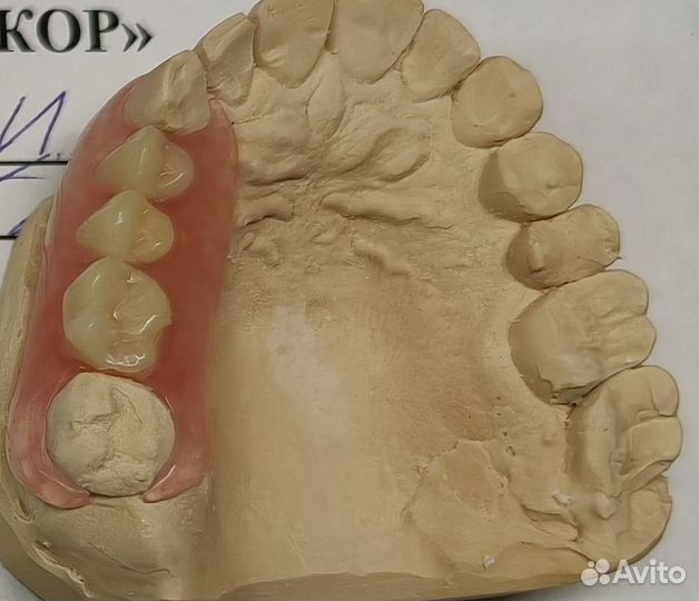 Съемные зубные протезы