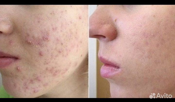 Крем Smart 27, от псориаза экземы аллергии