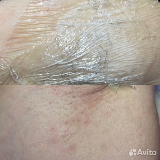 Электроэпиляция