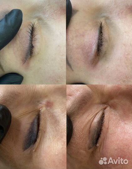 Удаление татуажа и тату