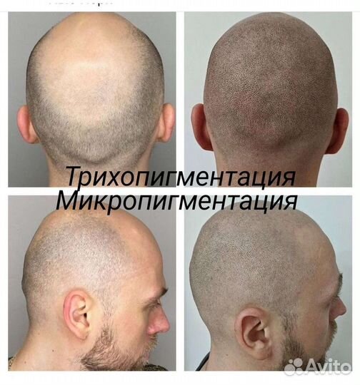 Трихопигментация кожи головы.Для мужчин и женщин