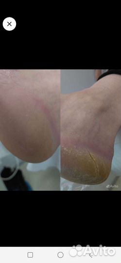 Педикюр подолог