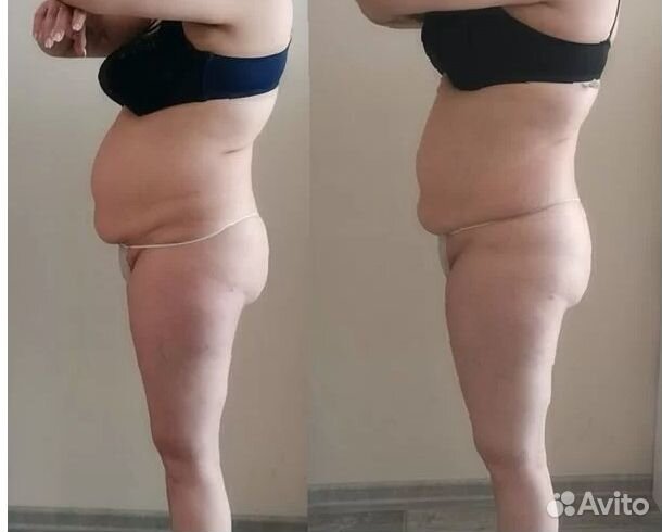 Ищу модель на криолиполиз