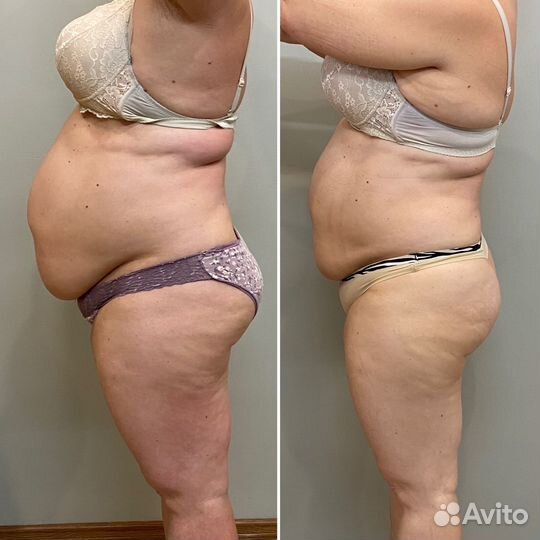 Аппаратное похудение