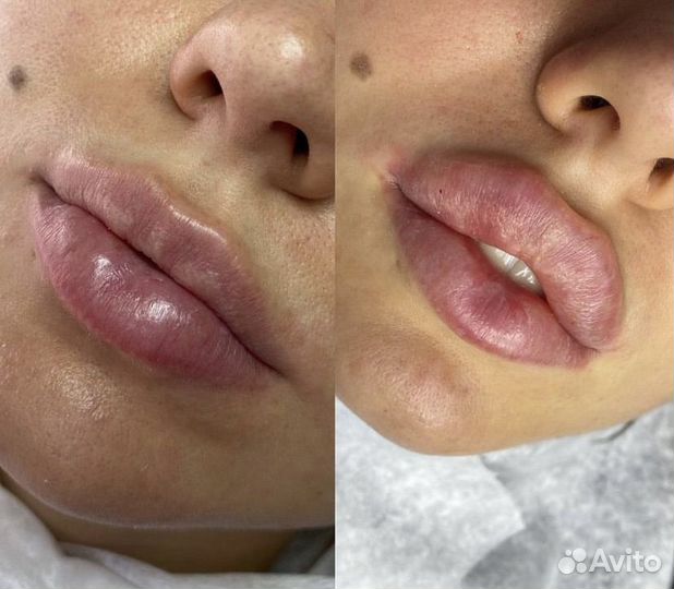 Увеличение губ