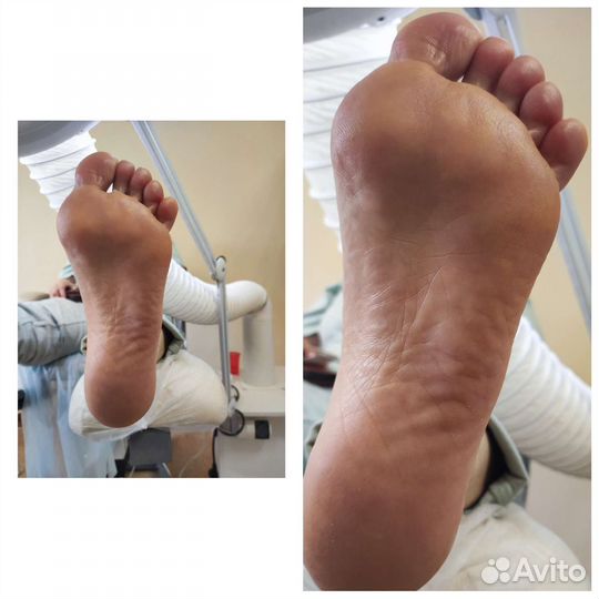 Аппаратный педикюр