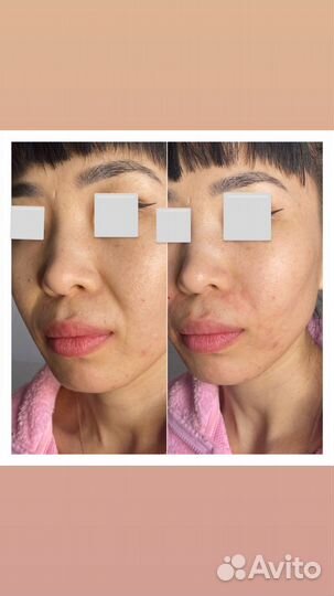 Мезонити,подтяжка лица