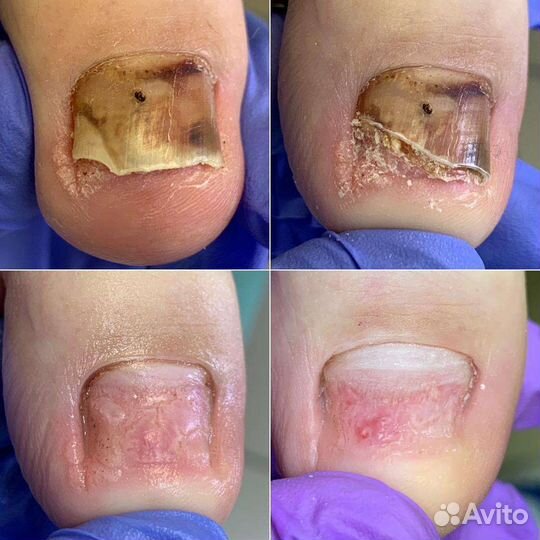 Педикюр,подологические услуги с выездом на дом