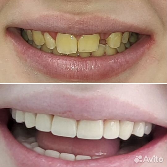Виниры на зубы