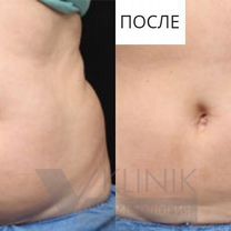 Коррекция фигуры, похудение, Севастополь