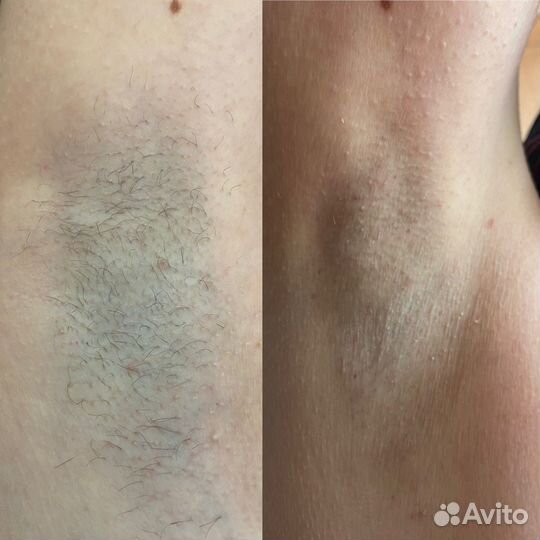 Депиляция воском