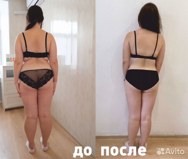 LPG массаж, эффективная коррекция фигуры