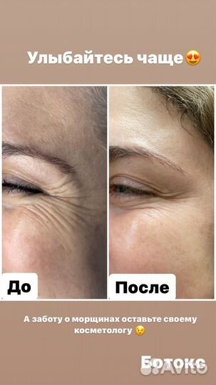 Ботокс