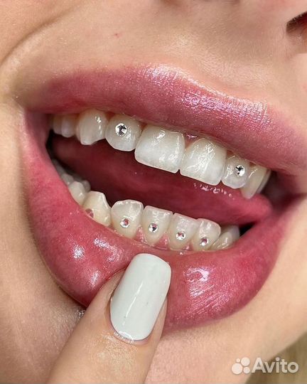 Скайсы установка на зубы кристаллы swarowski