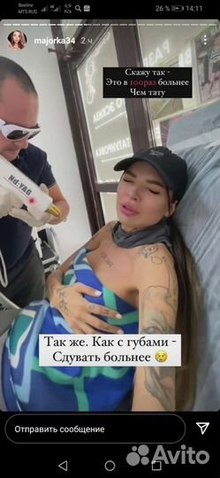 Удаление татуировок и татуажа. Карбоновый пилинг