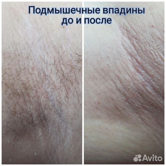 Депиляция