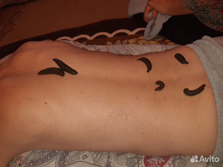 Пиявки медицинские