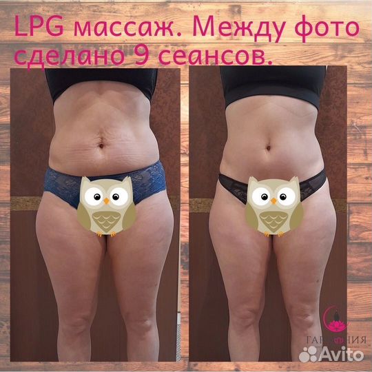 Массаж LPG