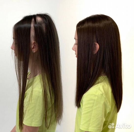 Установка систем замещения волос