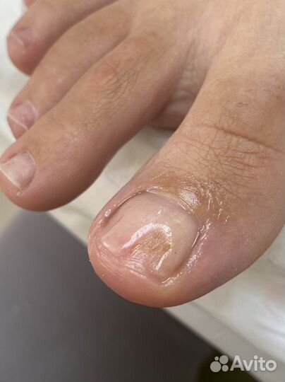 Педикюр подолог