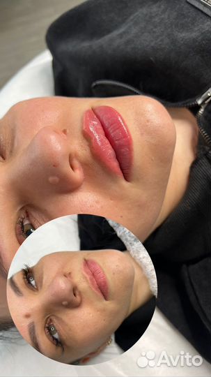 Увеличение губ