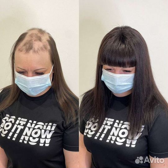 Замещения волос