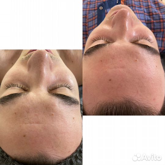 Скульптурно-буккальный массаж лица