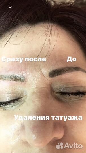 Удаления татуировок и татуажа