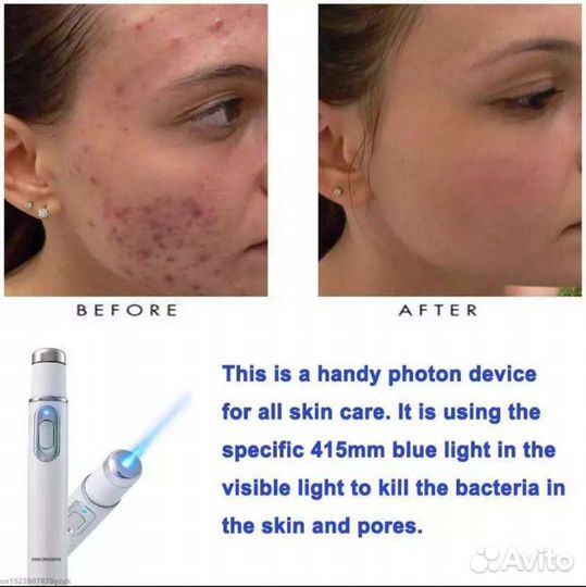 Лазерная ручка от прыщей